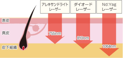ソプラノチタニウム説明図